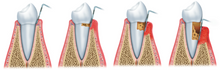 Load image into Gallery viewer, set: 3 x Parodont Gel, tratament parodontoză și gingii, 10 ml