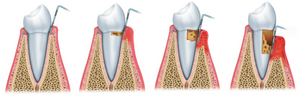 set: 3 x Parodont Gel, tratament parodontoză și gingii, 10 ml